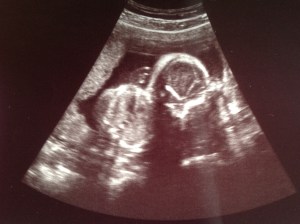 baby ultrasound picture
